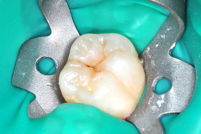 歯内療法(根管治療)